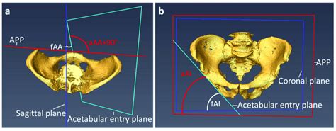 Measurement Of The Functional And Anatomical Acetabular Orientation