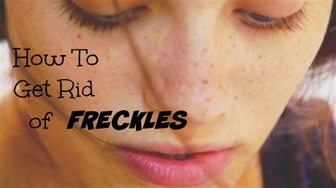How To Get Rid Of Freckles Youtube