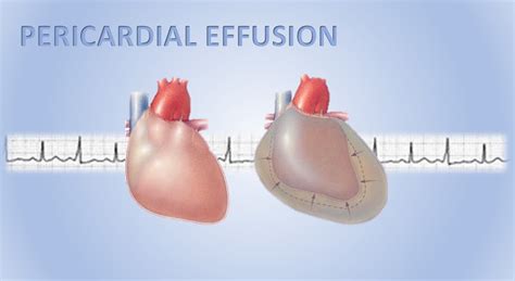 Pericardial Effusion Causes Symptoms Diagnosis Prognosis Treatment