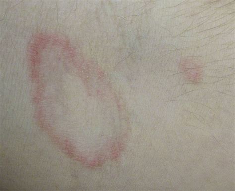 Ich hab ihn dann mit einer nadel aufgestochen und es ist eine sehr zähflüssige klare, gelbliche flüssigkeit ausgetreten. Runde Rötung in Armbeuge? (Haut, Ausschlag)