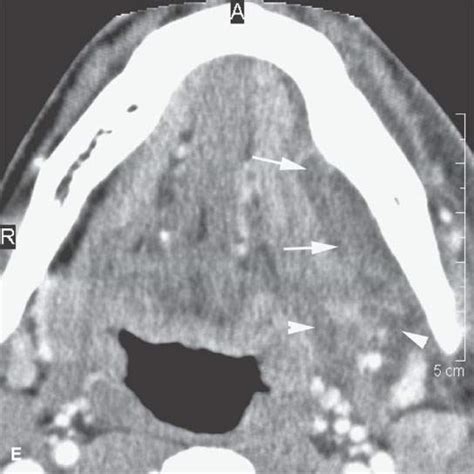 Acute And Subacute Mandibular And Dental Infections And Noninfectious