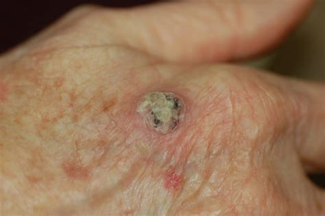 Keratoacanthoma Squamous Cell Carcinoma Of The Keratoacanthoma Type