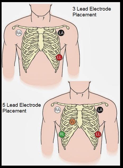 3 Electrode And 5 Electrode Lead Placement
