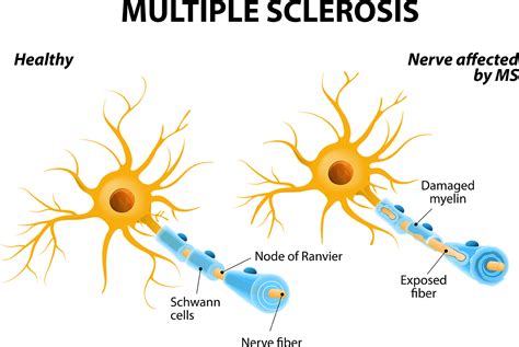 7 Early Warning Signs Of Multiple Sclerosis Regional Neurological