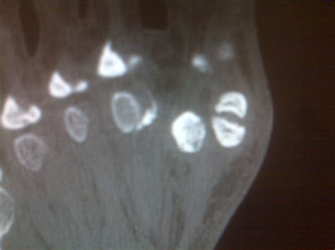 Foot and Ankle Problems By Dr. Richard Blake: Sesamoid Fracture: Email