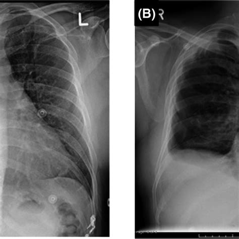 Chest X‐ray A Chest Posteroanterior View Showing Redemonstration Of