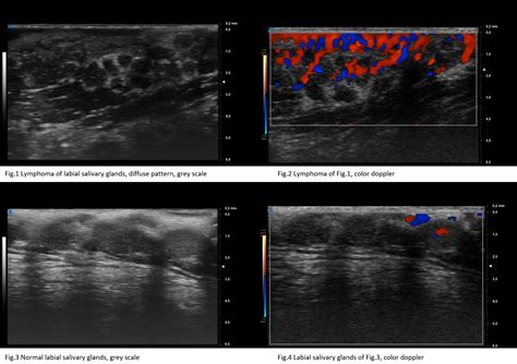 Ultra High‐frequency Ultrasound Of Labial Salivary Glands In Primary