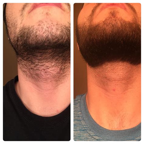 Today, that number is about 51 percent. Minoxidil Beard Reddit Before And After Pictures | Beard ...