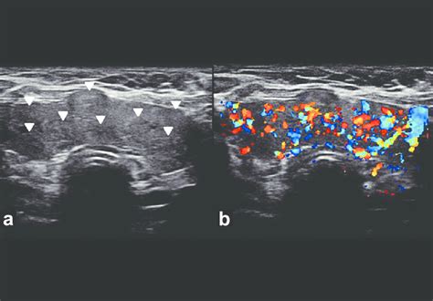 Multinodular Goiter Transverse Gray Scale Ultrasound A And Color