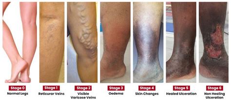 What Are The Stages Of Varicose Veins By Dr Kunal Arora