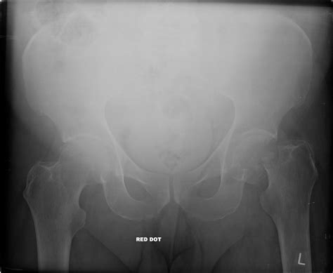 Subcapital Left Femoral Neck Fracture