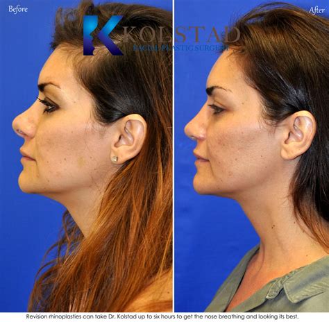 Revision Rhinoplasty Before And After Gallery Dr Kolstad San Diego