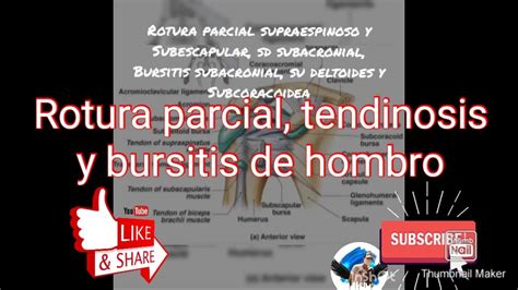 Rotura Parcial Y Tendinosis Del Supraespinoso Y Subescapular Y
