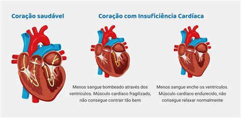 Insuficiência Cardíaca Grau 3