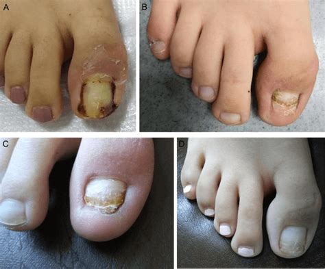 A Step By Step Approach Of The In Situ Thin Split Thickness Toe Nail