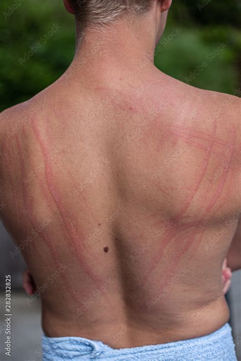 Dermatographic Urticaria Also Known As Dermographism Dermatographism