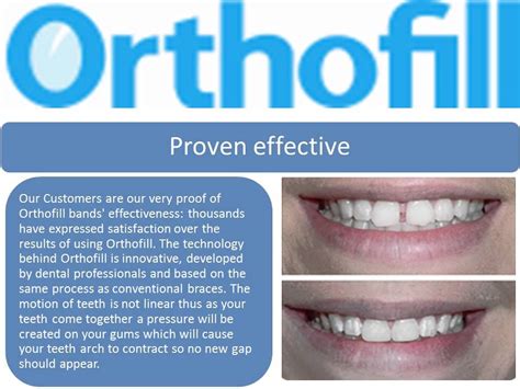 Because braces are the only way to get rid of all the imperfection in your mouth at once. Ortho Fill Front Teeth Gap - YouTube