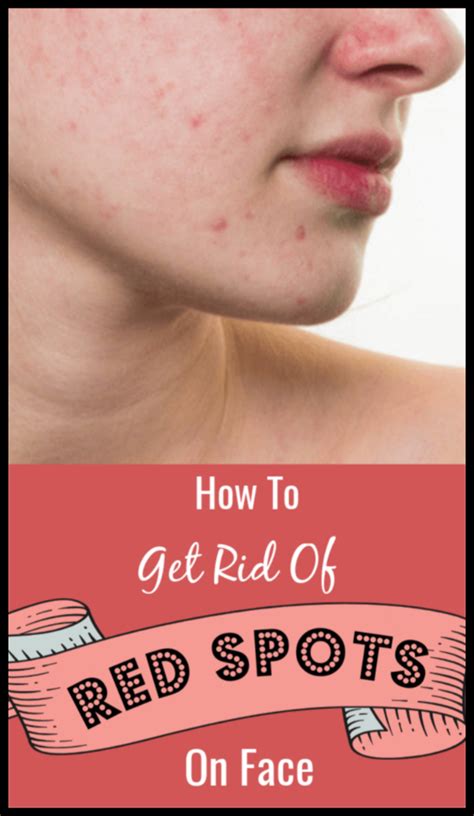 How To Get Rid Of Red Spots On Face Effective Home Remedies Skin