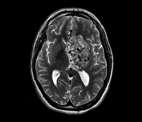 Subarachnoid Hemorrhage Mri Scan Bild Kaufen 13599590 Science