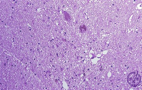 17nervous System 5 Parkinson Diseasepathology Core Pictures
