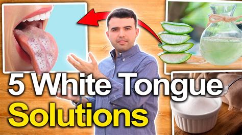 5 White Tongue Causes And Natural Treatments Youtube