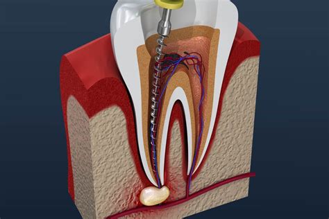 Does Your Tooth Hurt A Dentist Explains When Root Canal Therapy Is Needed