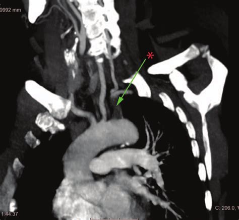 Magnetic Resonance Angiography Arrow Shows Thrombus In The Subclavian