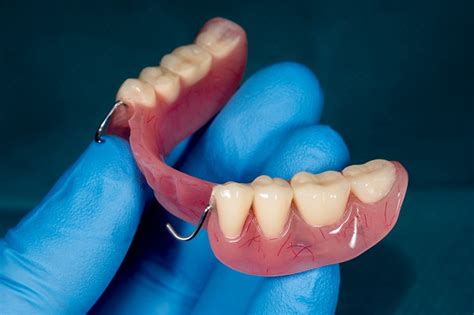 Partial Dentures A Comprehensive Overview