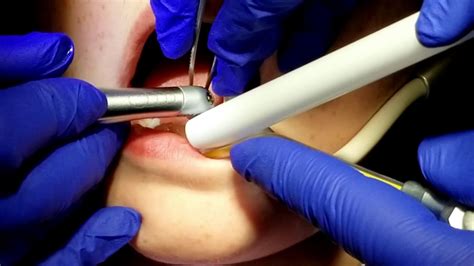 Tongue Tied Frenectomy Youtube