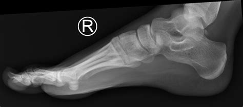 Normal Foot X Rays Image