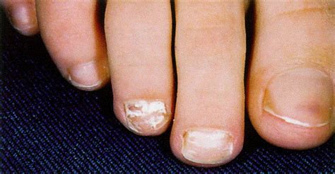 Childhood White Superficial Onychomycosis Caused By Trichophyton Rubrum