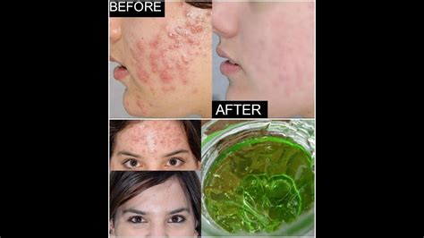 Homemade Remedy To Heal Acne Scars Sunburn And Get Soft Glowing