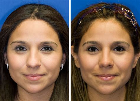 Incredible Liquid Rhinoplasty Before And After Bulbous Tip References