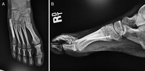 Delayed Union Of A Jones Fracture In A Patient With Rothmund Thomson