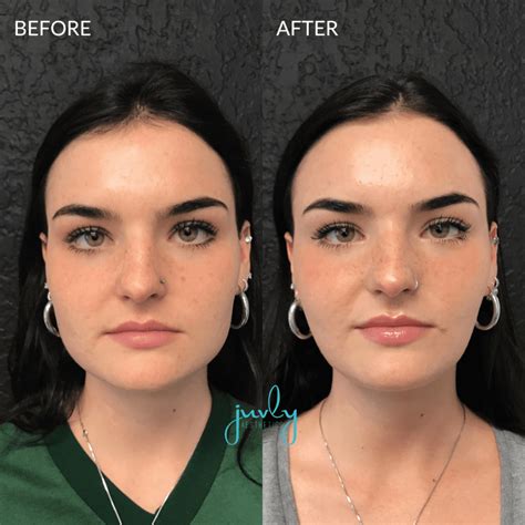Juvly Aesthetics Gallery Face Slimming Juvly Aesthetics