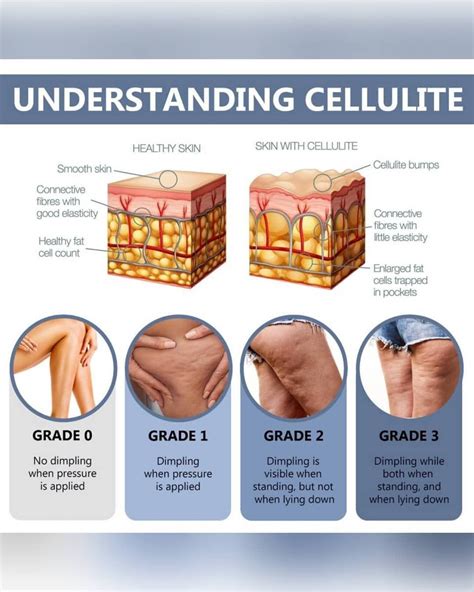 Cellulite Juverne