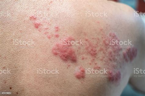 Shingles Herpes Zoster Varicellazoster Virus Skin Rash And Blisters