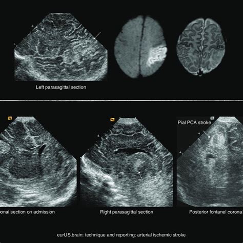 Technique And Reporting Posterior Fontanel Images At 24 Weeks Ga