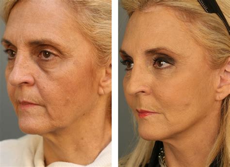 How To Execute Facelift Exercises To Transform Your Face A Facial