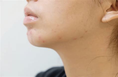 Closed comedones are simply comedones that are not exposed to air. Closed Comedones Extraction - LifeStyleAbout