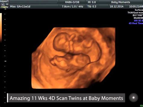 Amazing Baby Scan Twins Uk Call 08000075076 Youtube