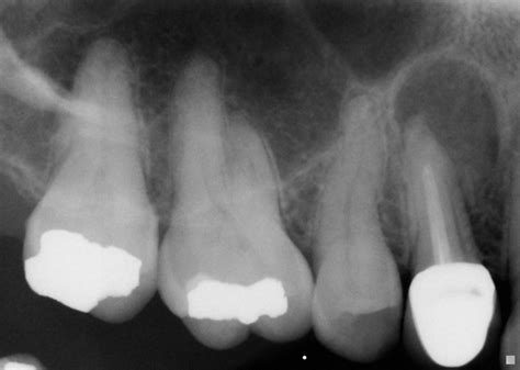 periapical radicular cyst dr g s toothpix