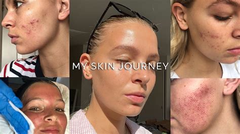 My Skin Journey Morpheus 8 Treatment Adult Acne Acne Scarring Youtube
