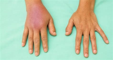 10 General Symptoms Of Cellulitis Facty Health