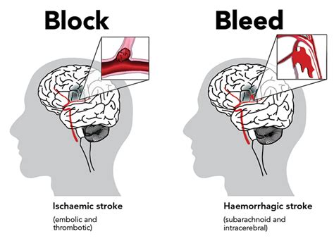 Understanding The Types Of Stroke Differentiating And Addressing The