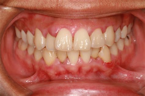 Bleeding Gums Gum Disease And Receding Gums With Sensitive Teeth