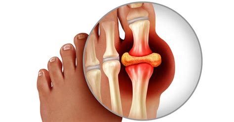 Why Does My Big Toe Joint Hurt A Podiatrist S View • Unisoles