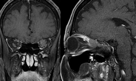 T1 Weighted Magnetic Resonance Imaging Of The Brain With Contrast