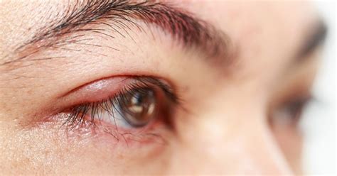 How To Get Rid Of Styes In Your Eyelids Livestrongcom