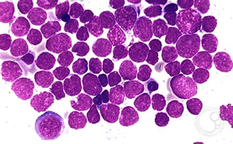 Precusor B Cell Acute Lymphoblastic Leukemia 4